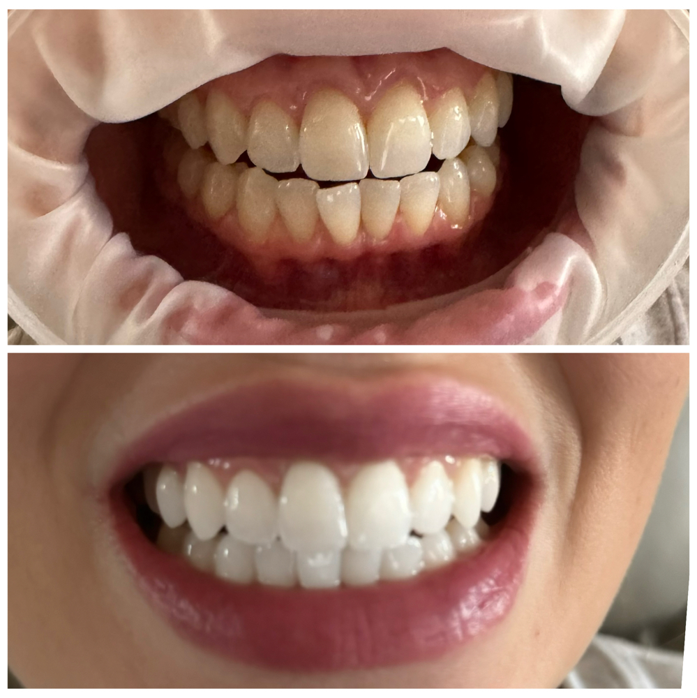 Teeth Whitening Touch Up at The Cosmetic Ardis in Goldsboro, NC