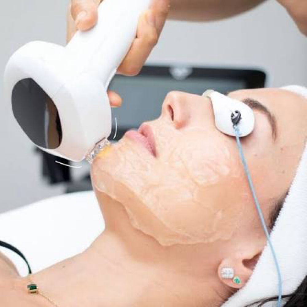 IPL Face + Neck + Chest at Luxe Level Aesthetics in Darien, CT