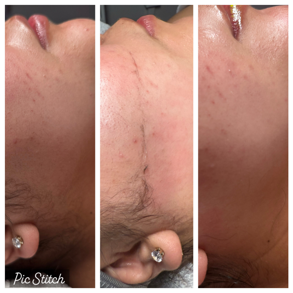 Dermaplaning Facial at BEAUTY OF SB in Santa Barbara, CA