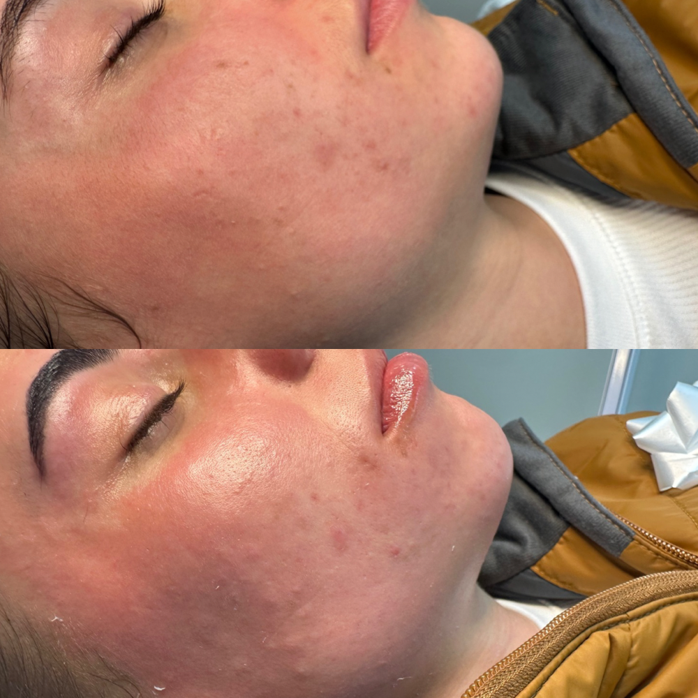 Acne Facial