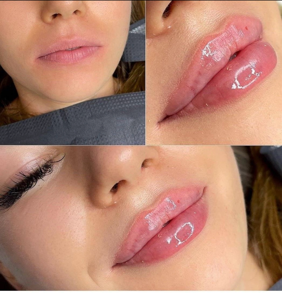 Lip Filler Injections