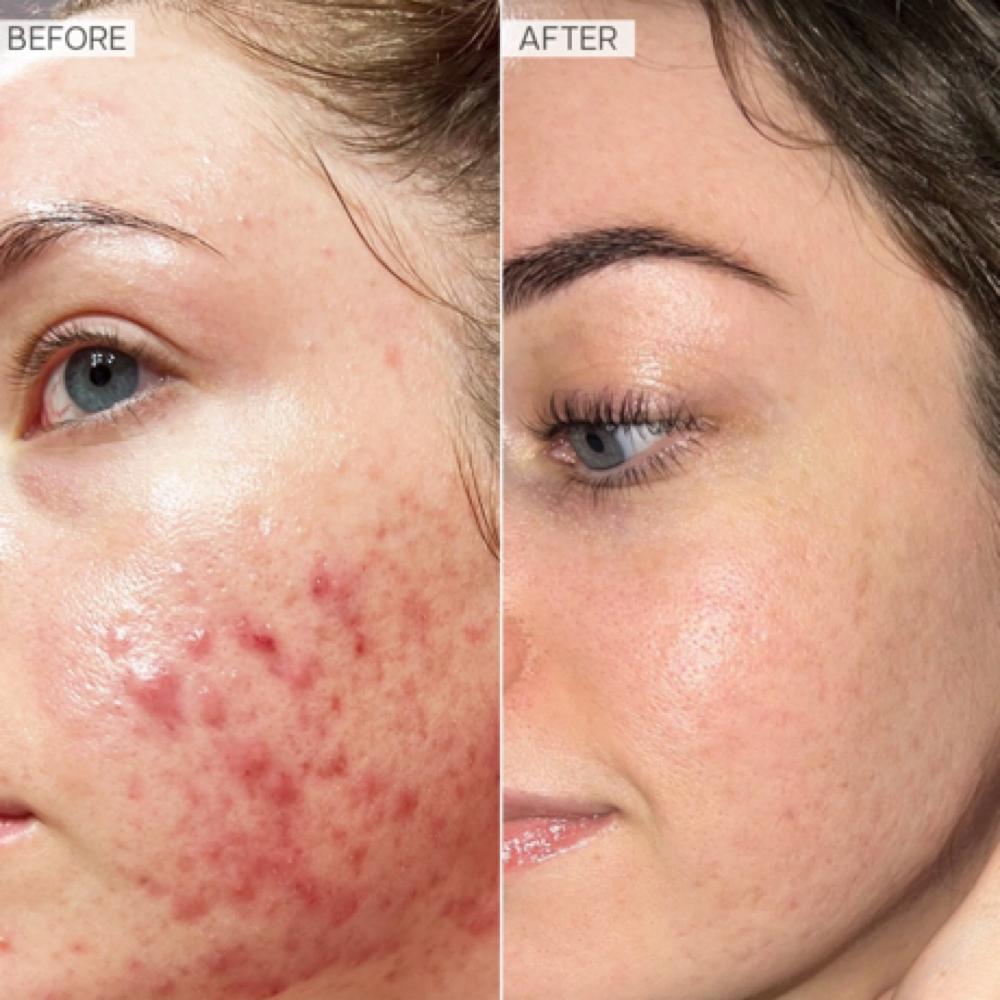 Acne consultation and Treatment at A&A Beauty Bliss in Cape Coral, FL