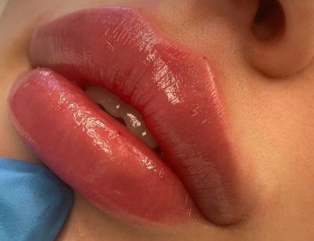 ✨Full lip filler syringe ✨