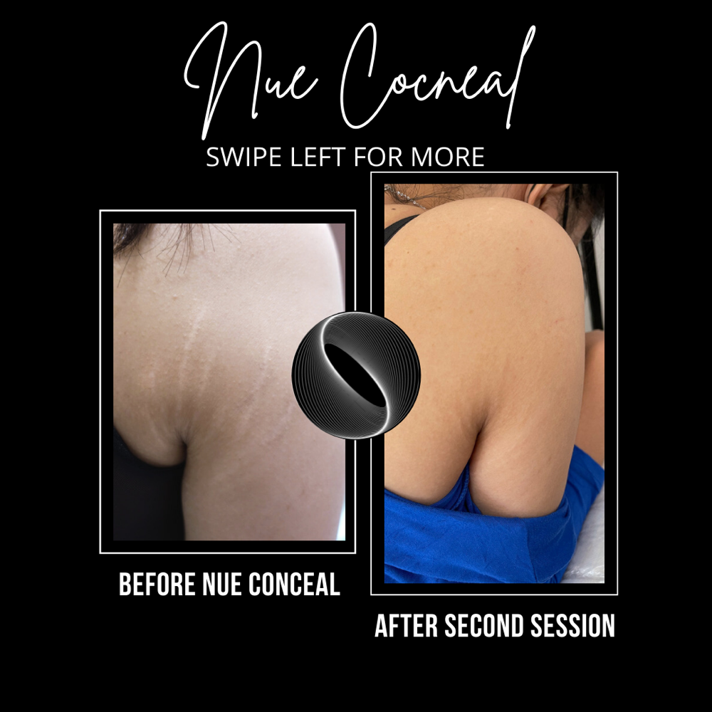 Inkless/Camo Stretchmarks Upper Arm