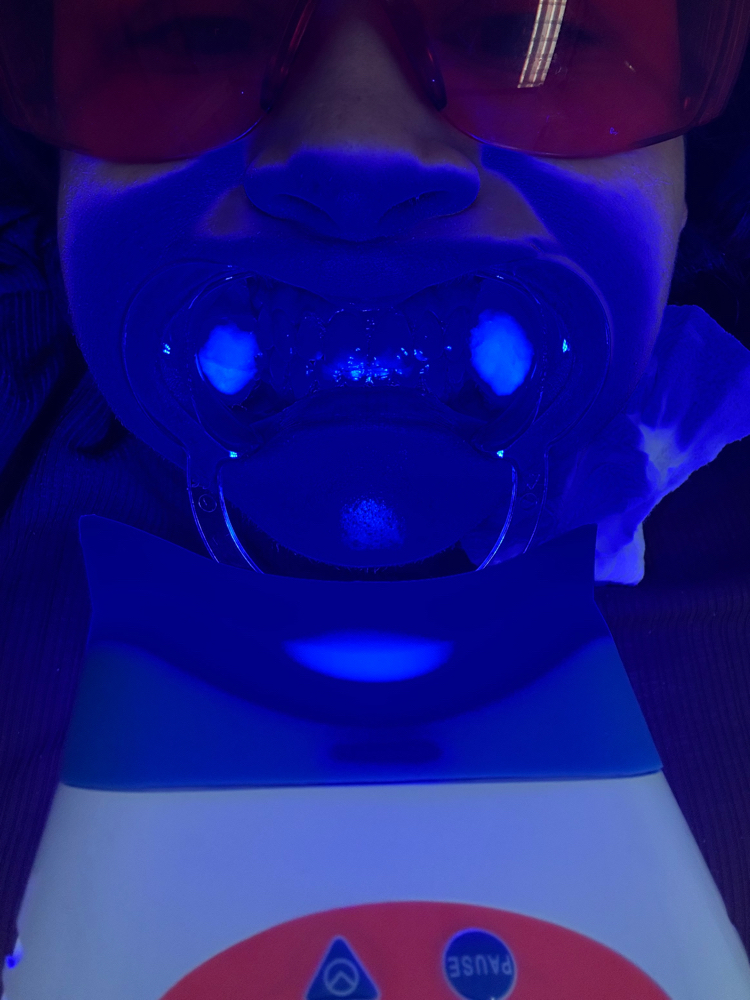Teeth Whitening