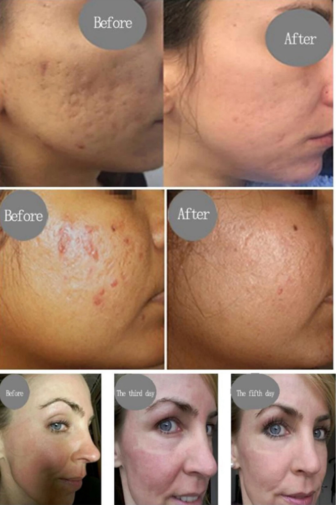 Plasma Fibroblast Full Face