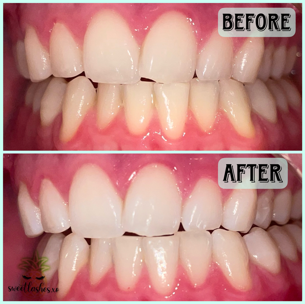 Teeth Whitening