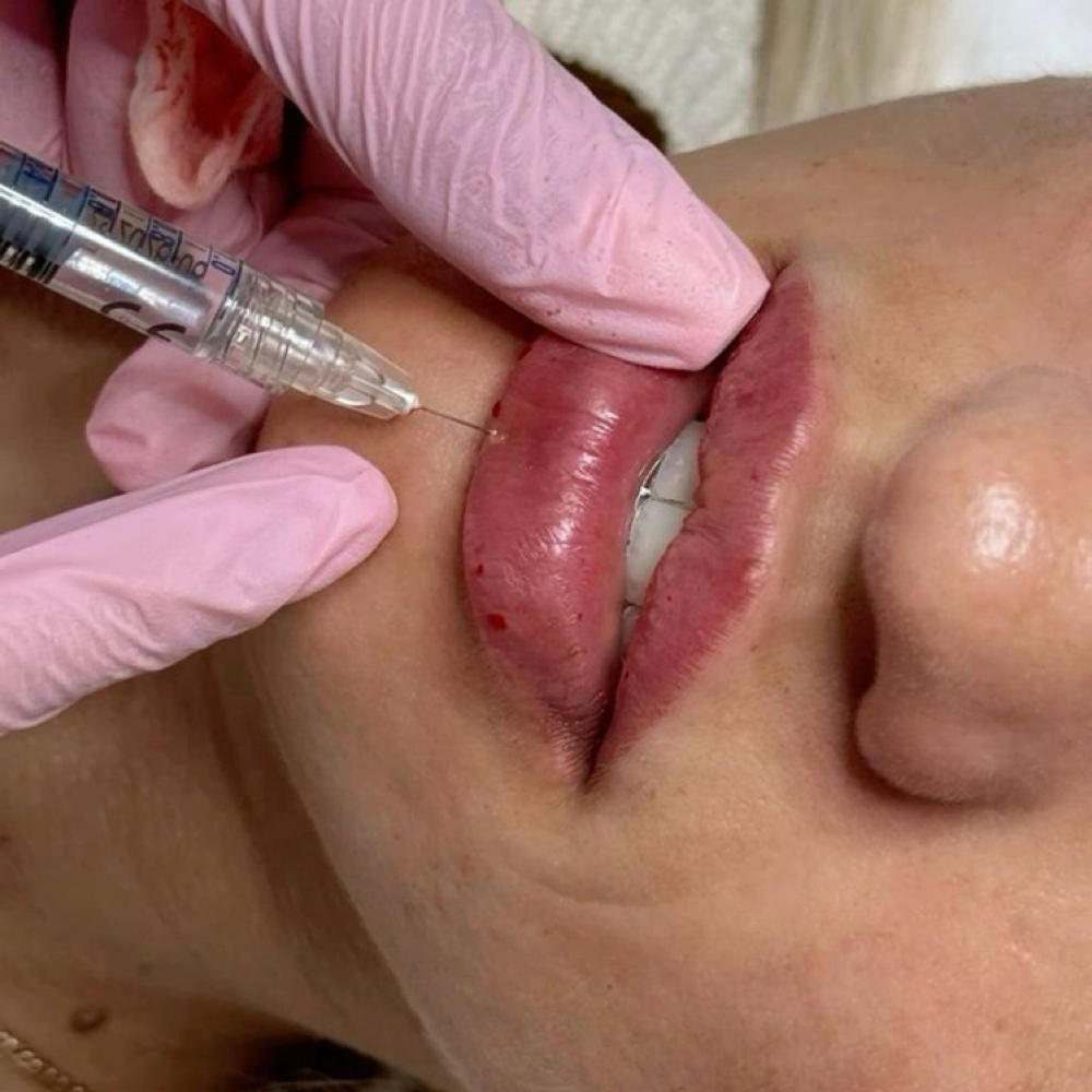 Lip Filler • Full Syringe at Cox Clinic & Aesthetics in Antlers, OK