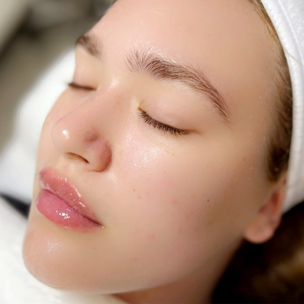 Teen Facial/ Acne Facial at Olivia Esthetics in Longview, TX
