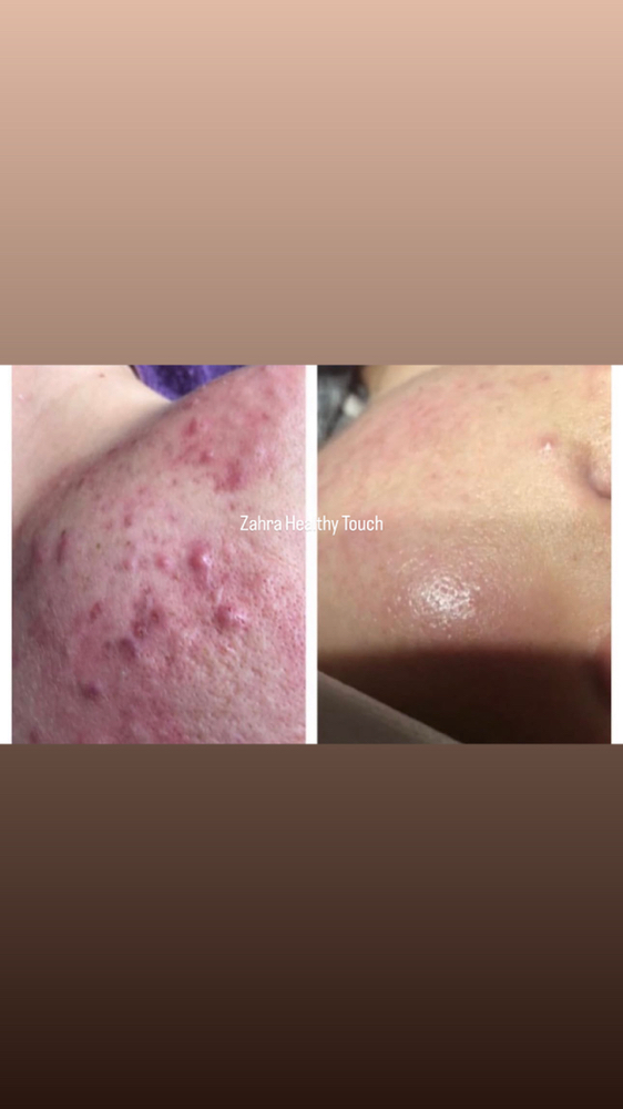 Acne Treatment Session