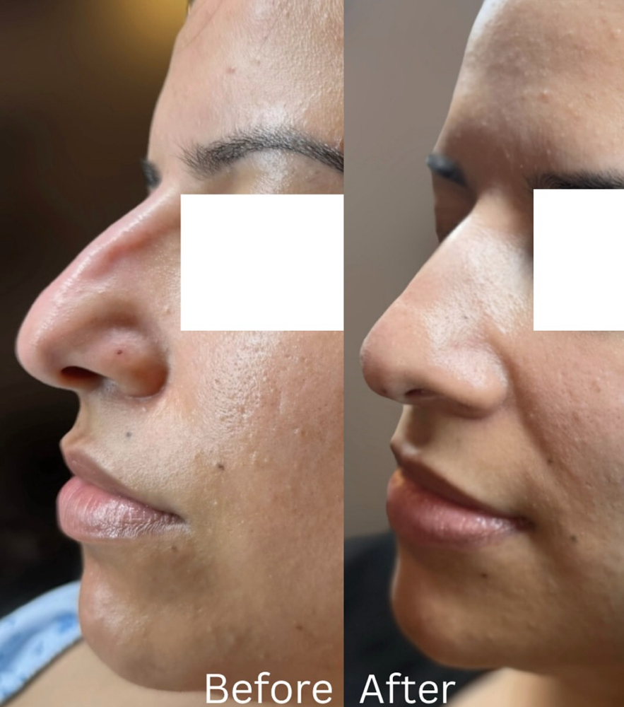 Liquid Rhinoplasty