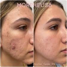 Morpheus8 Scars