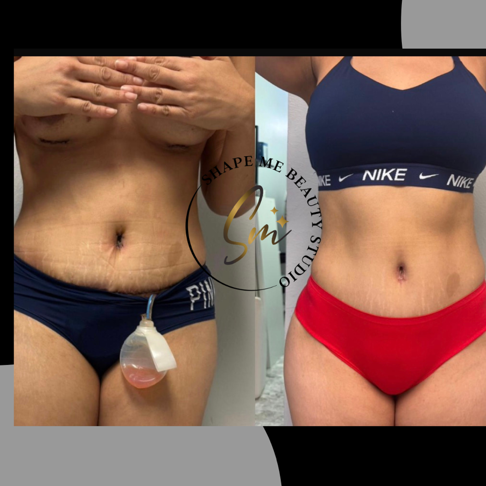 Post Op service at Shape Me Beauty Studio in Midland, TX