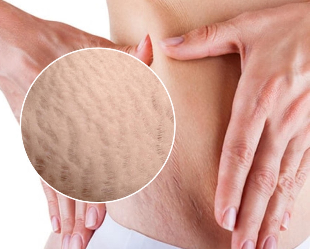 Stretch Marks