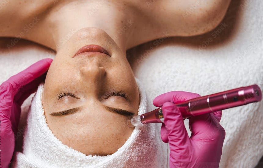 Microneedling