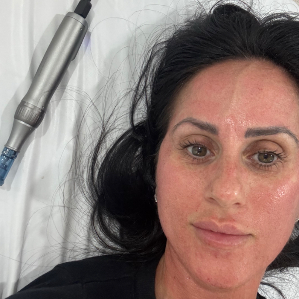 Microneedling at Sisthetics Skincare in Hollywood, FL