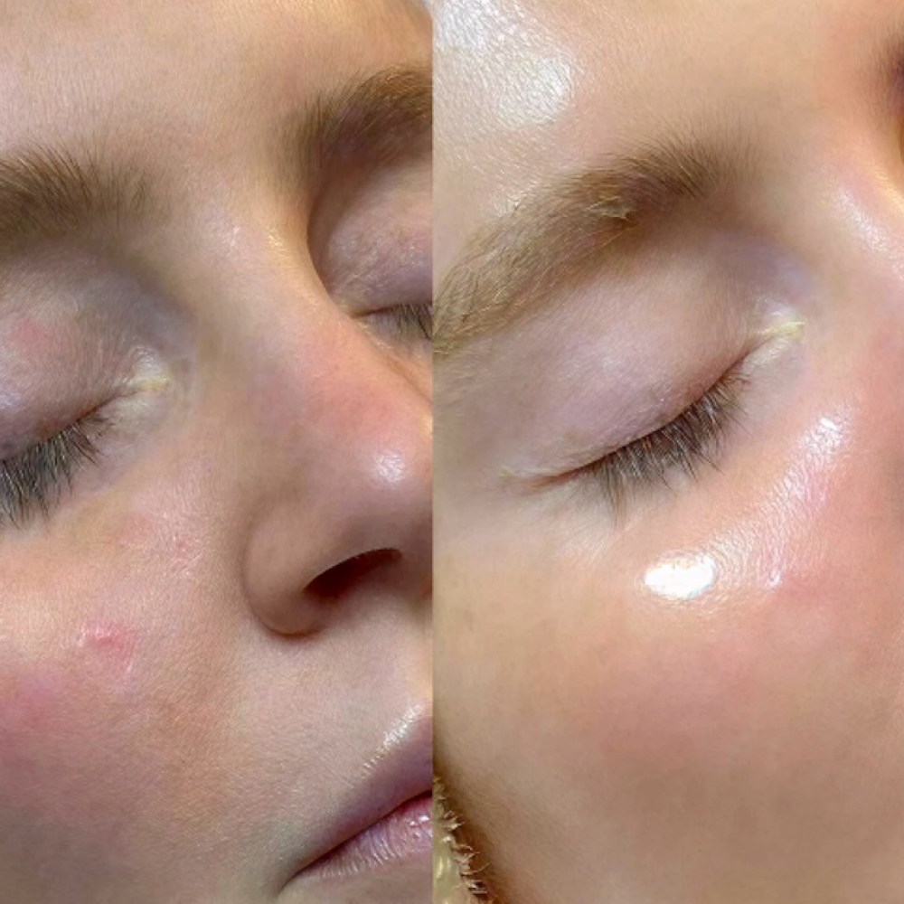 Add On Hydrafacial at Re Nu Esthetics by Trina in Ardmore, OK