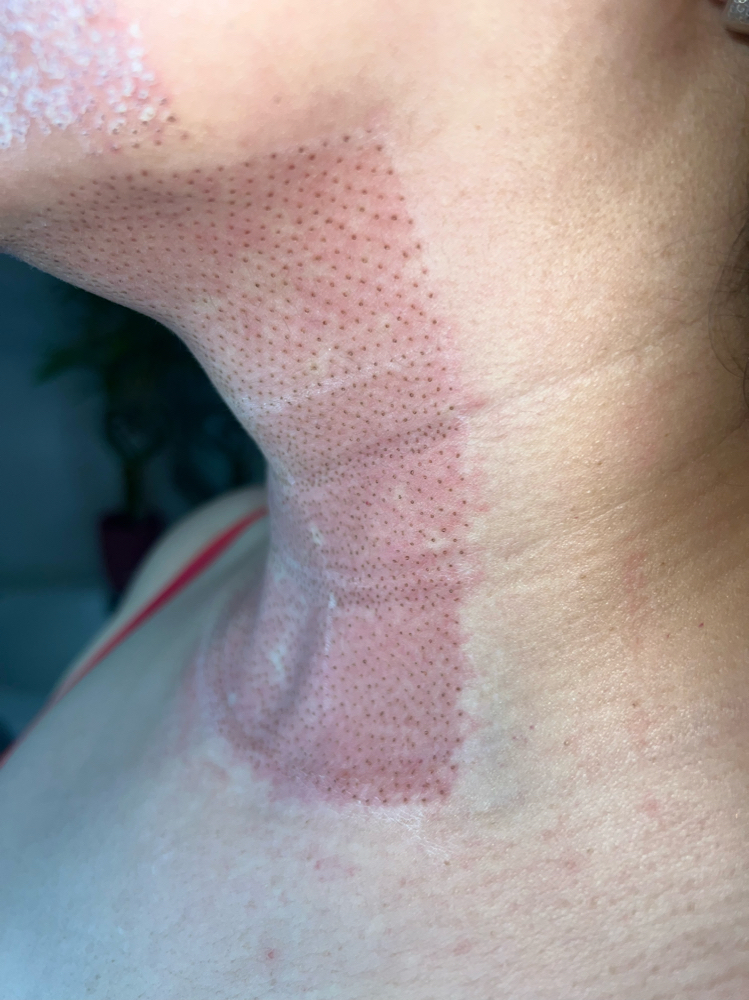 Half Neck Lift