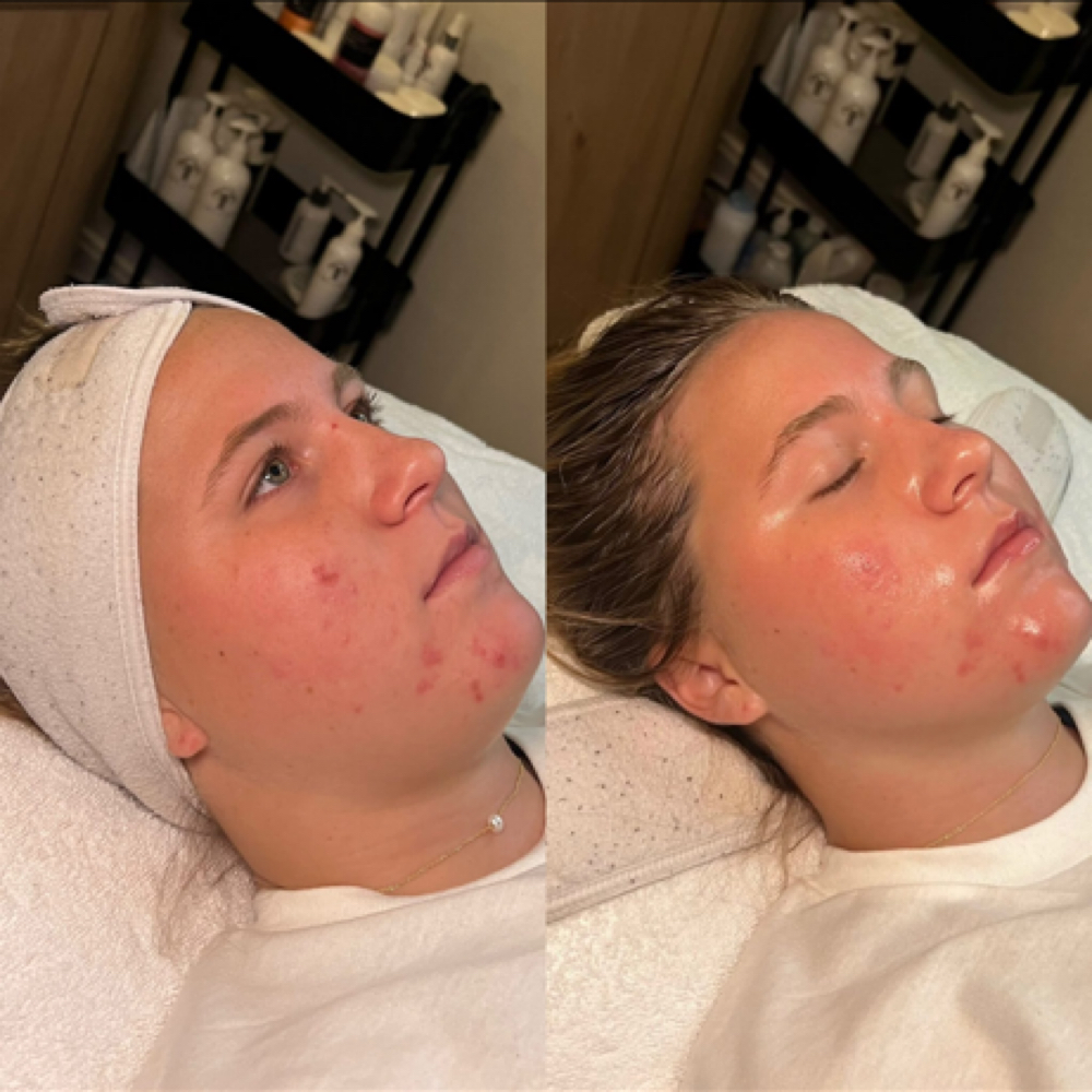 Acne Lift Facial at Bare Beauty By Alexis in Bay Saint Louis, MS