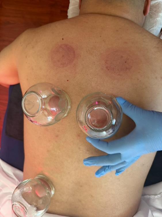 Fire Cupping at The Floating Lotus in Pico Rivera, CA