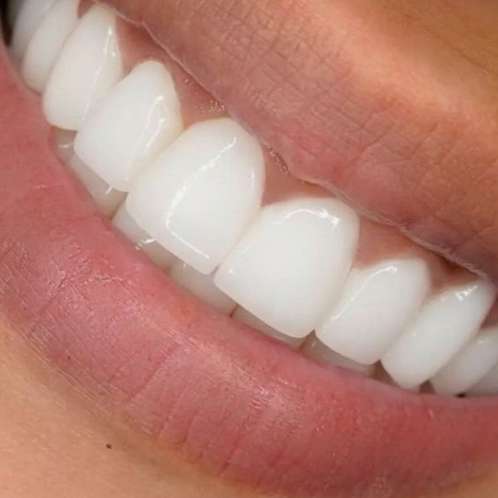 Teeth Whitening at Glowing With Gabby in Abilene, TX