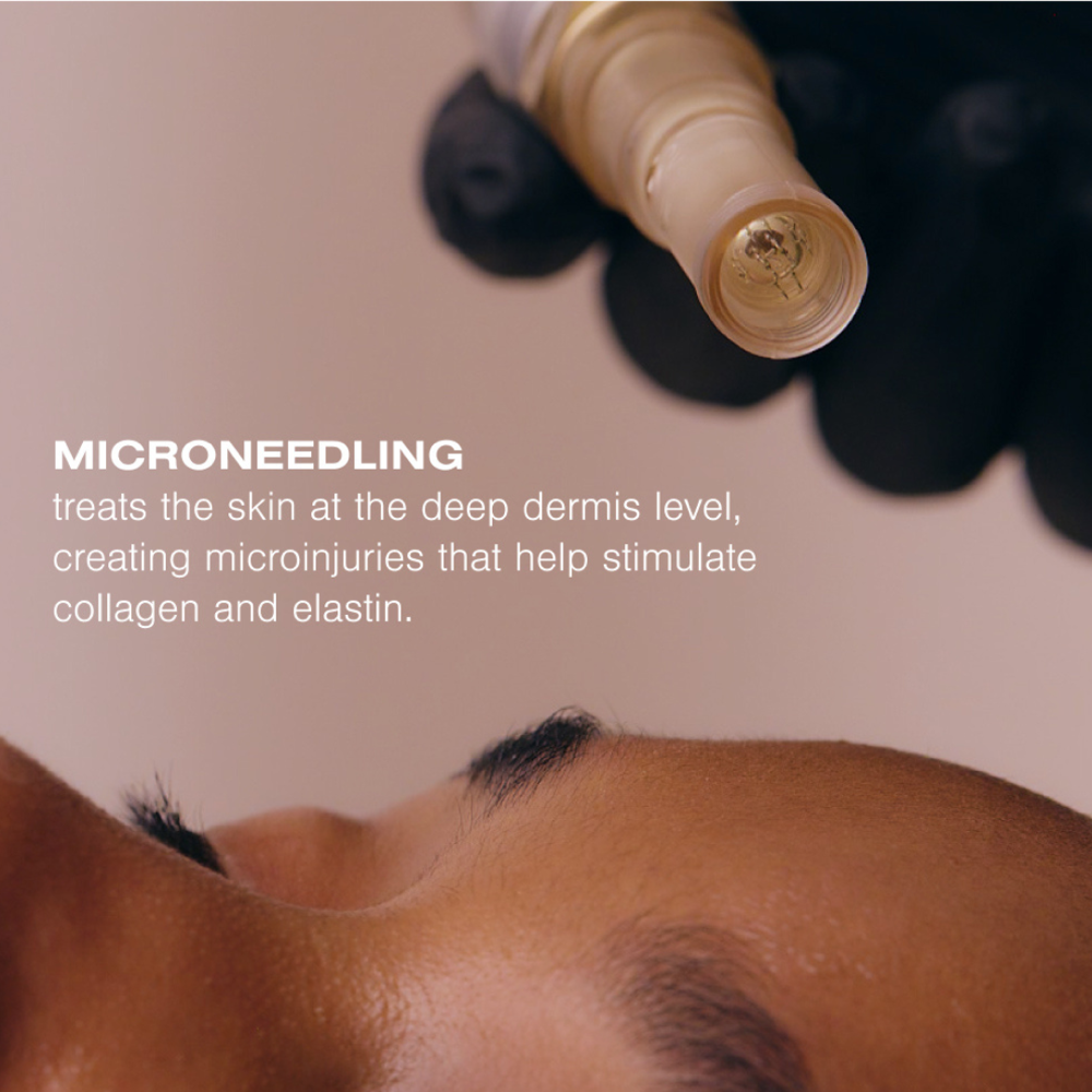 Microneedling Facial