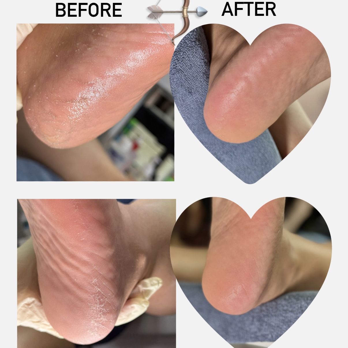 Add-on: Extreme Callus Removal
