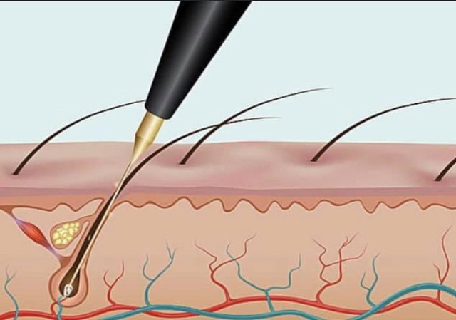 Electrolysis