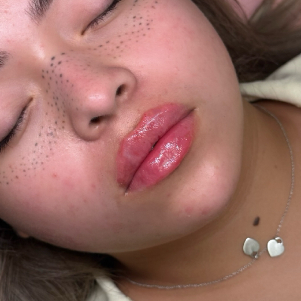 1ML LIP FILLER -READ DESCRIPTION at Kimspa&beauty in Dallas, TX