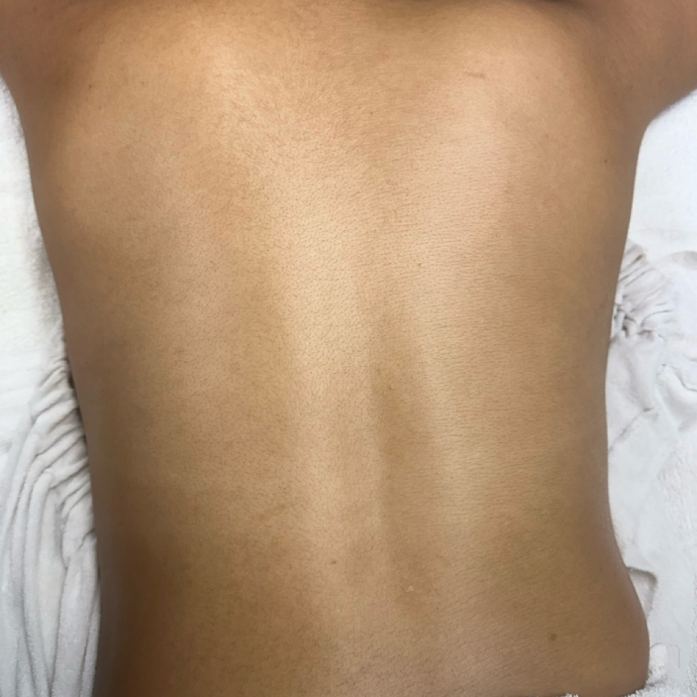 ACE Bacial [Back Facial] at ACESTHETICS LLC in Milford, CT