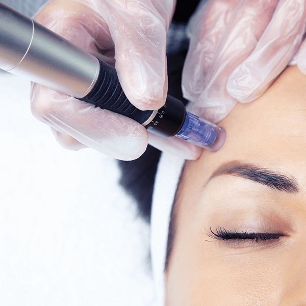 Microneedling With Facial