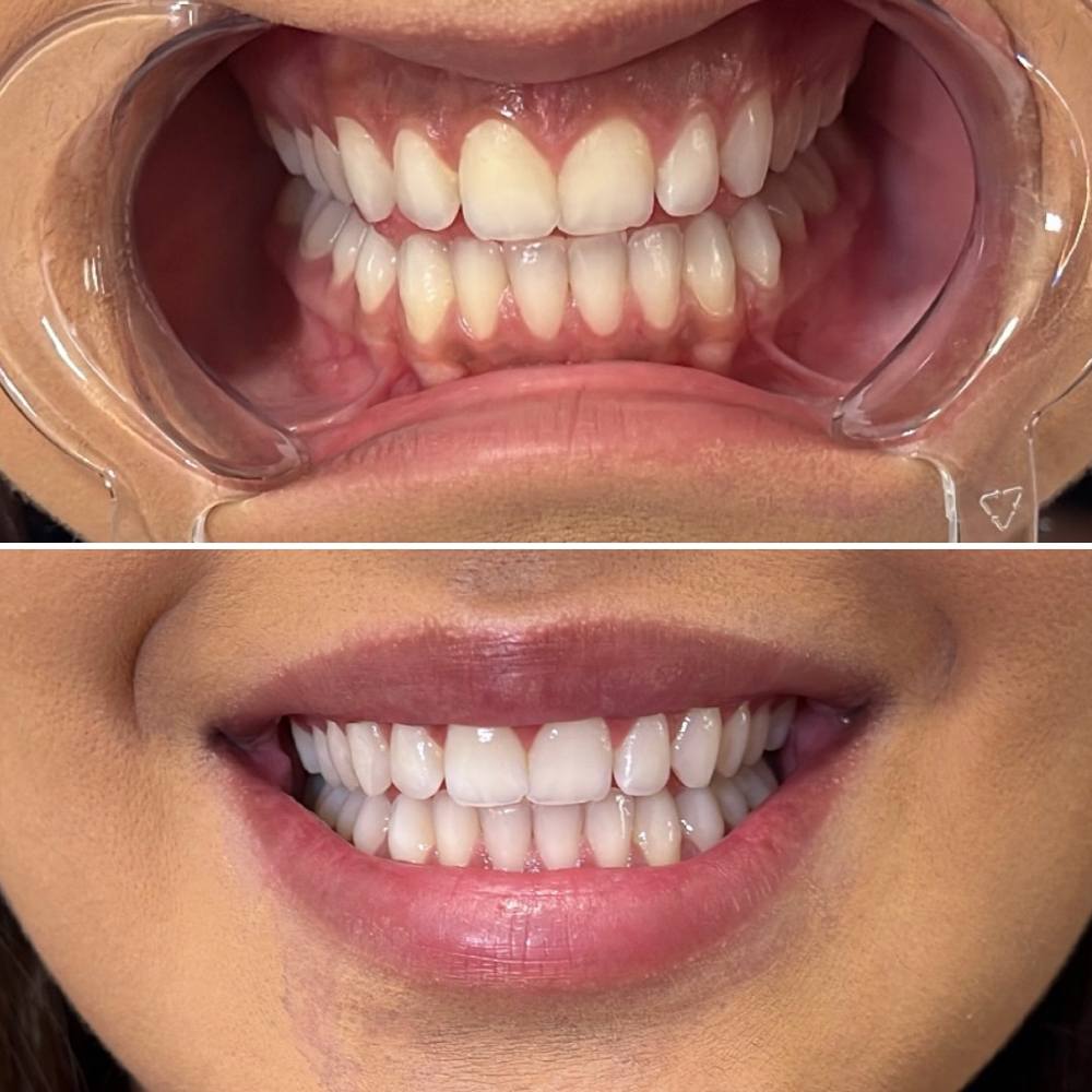 Cosmetic Teeth Whitening
