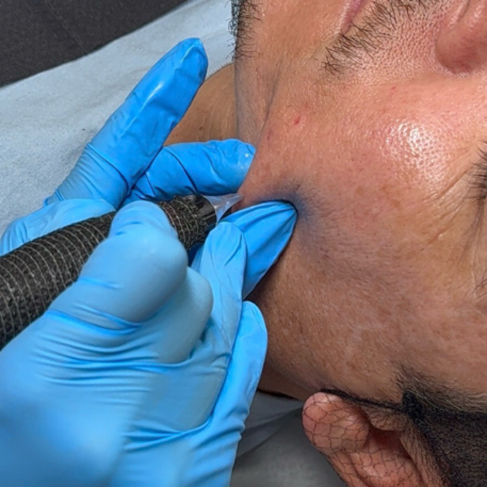 Acne Scar Treatment at Skin Luminescence Co in Ft. Myers, FL