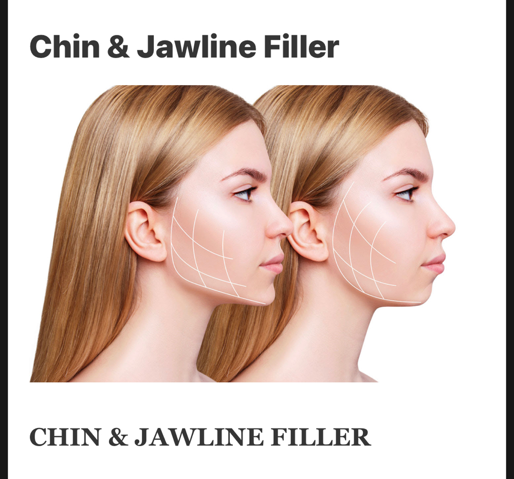 Jawline/Chin Filler Holly