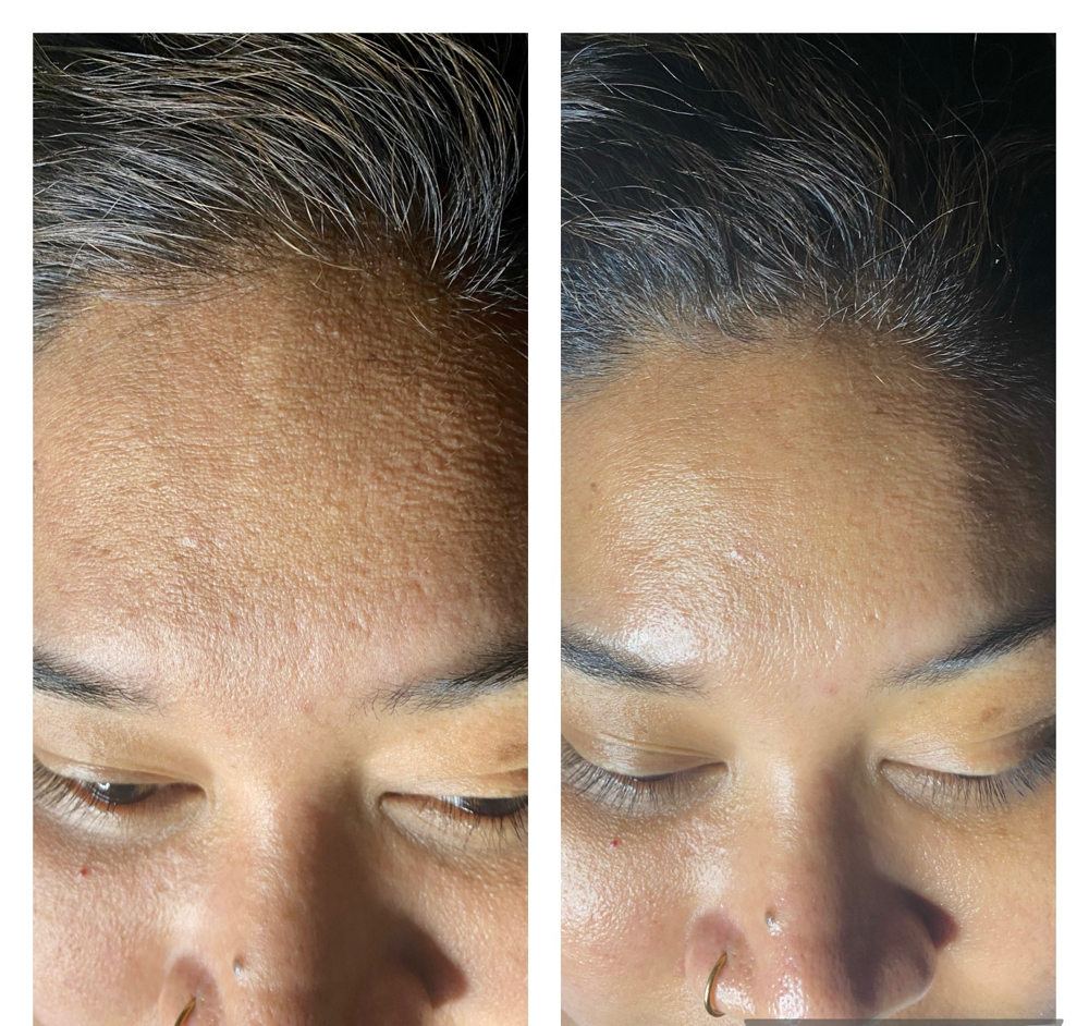 Corrective Skin Peel