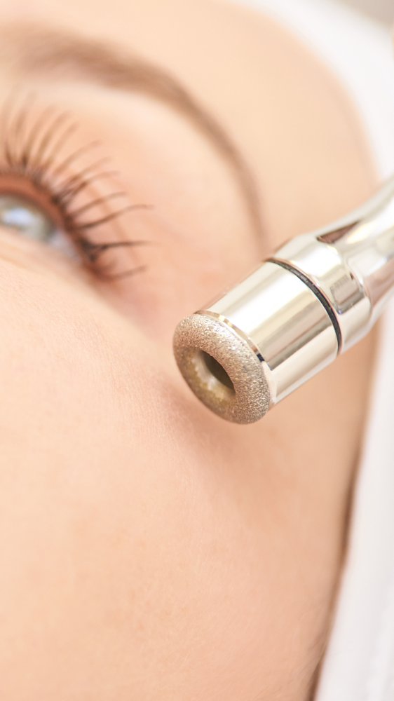 Microdermabration Facial at Dreas Body Sculpting in Napa, CA