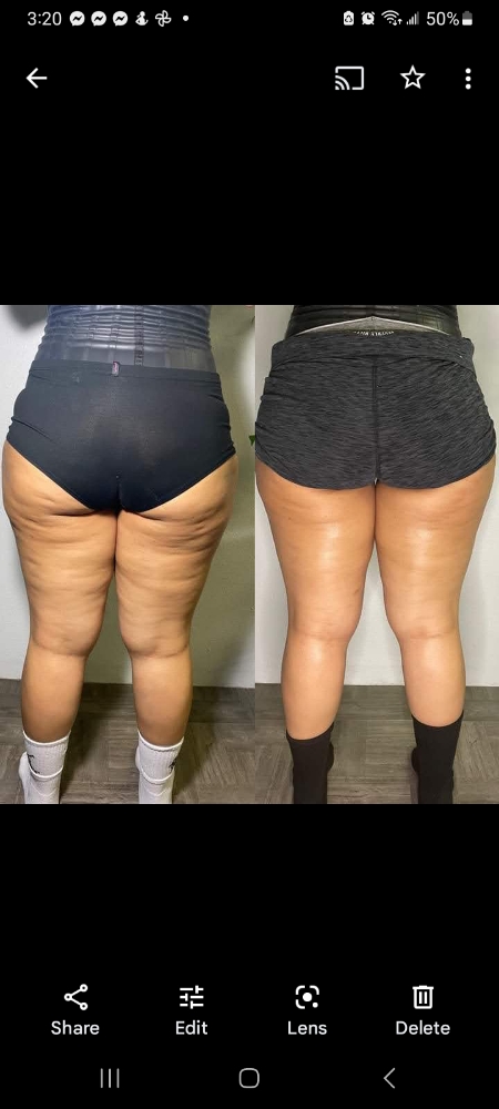 4  Session  Skin Tightening
