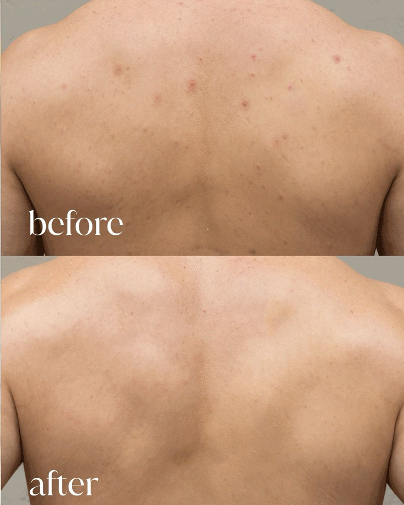 Back Chemical Peel at RadiantSkinBar in Brigham City, UT