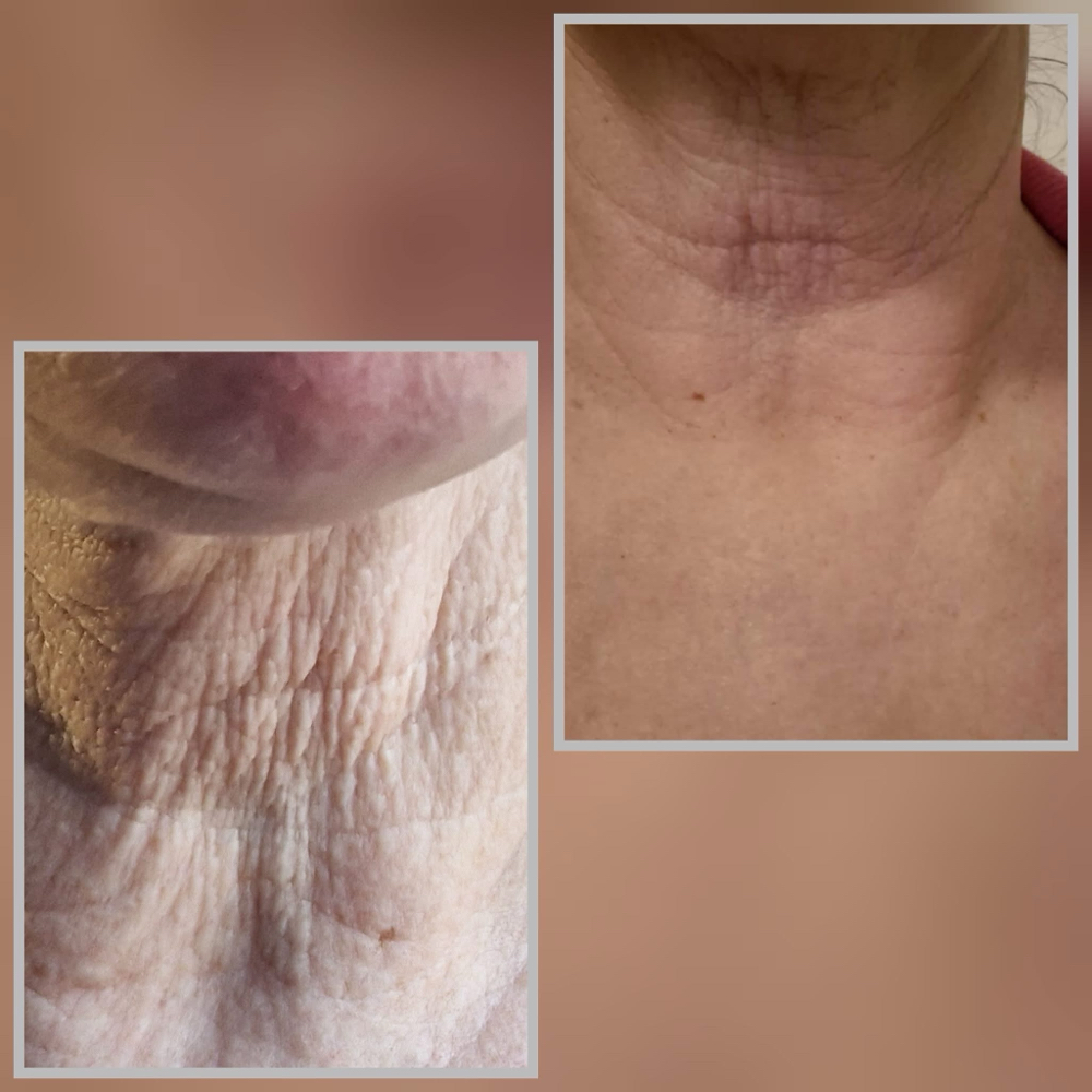 Neck Plasma Fibroblast