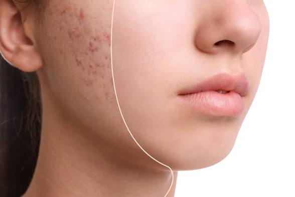 Acne scars at Natural Glow in Grand Praire, TX