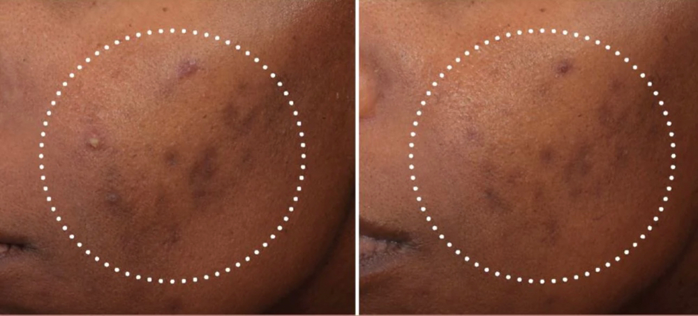 Pigment Correction Facial