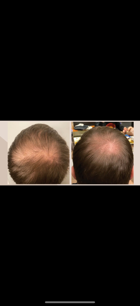 Microneedle Exosomes Hair Regrowth