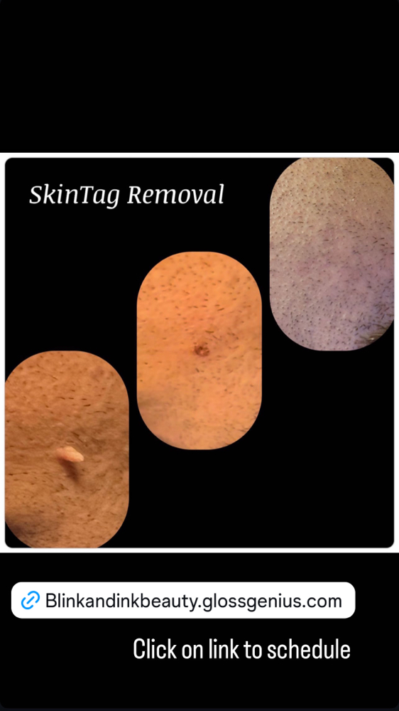 Skin Tag Removal