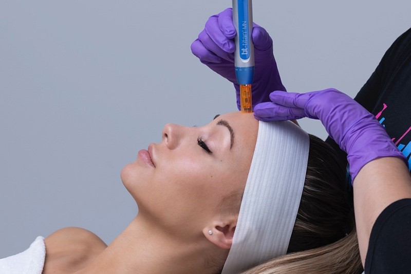 Add Channeling Microexfoliation