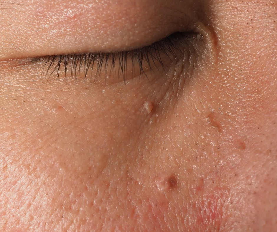 Targeted Lesion Removal