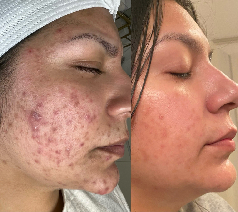 Light Chemical Peel Facial at Jisell Aesthetics in Houston, TX