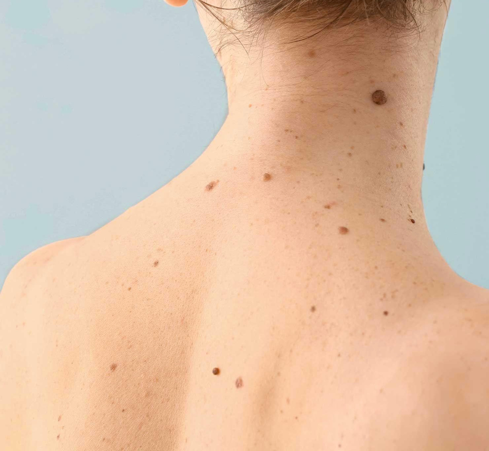 Skin Tag Removal