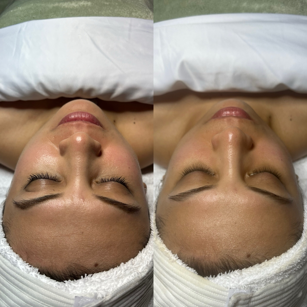 Microdermabrasion Facial