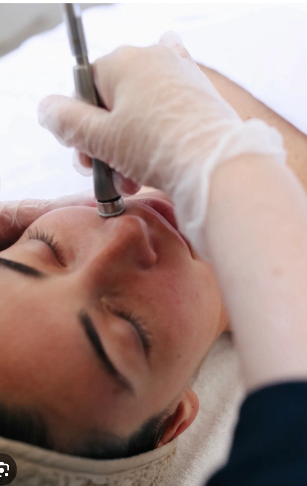 Micro Abrasion Facial