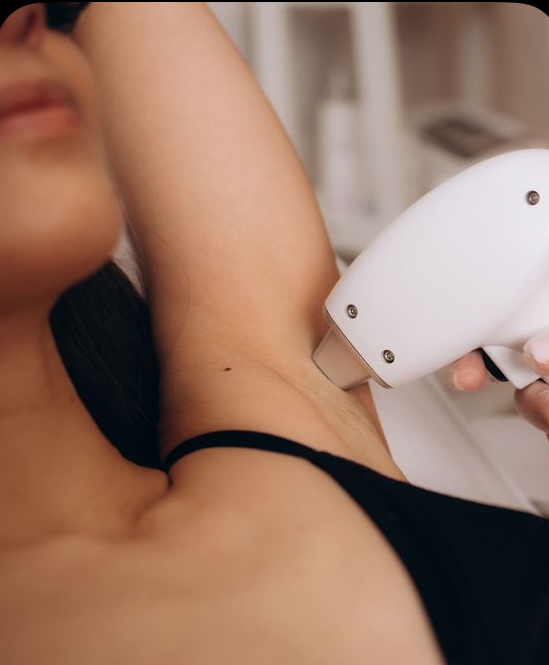 Laser hair removal